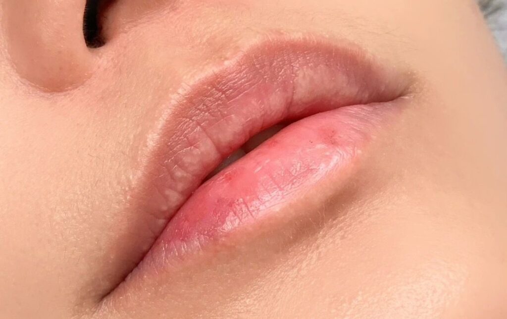 ローマピンク施術前