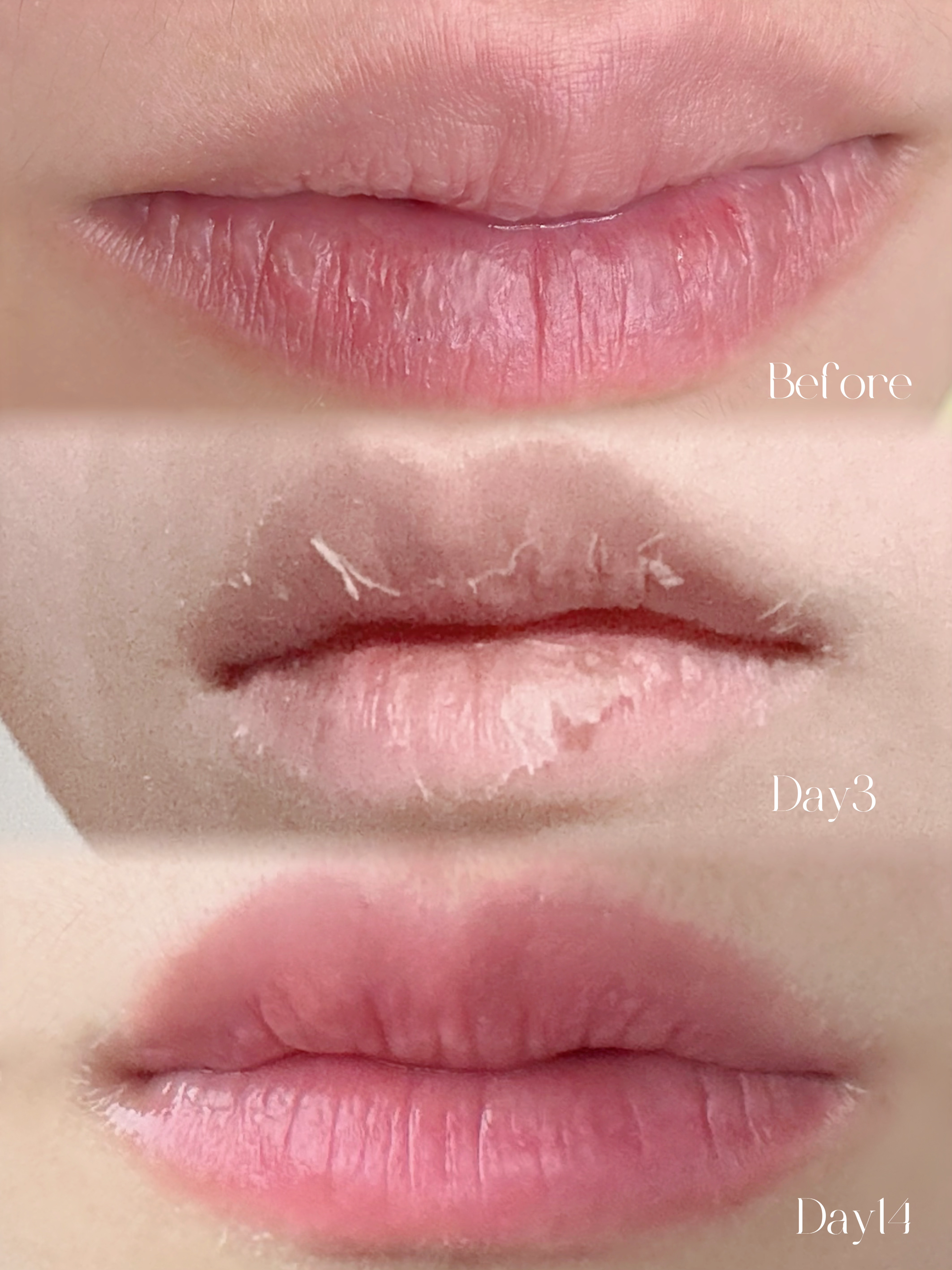 ローマピンク 唇の症例写真 Before→After